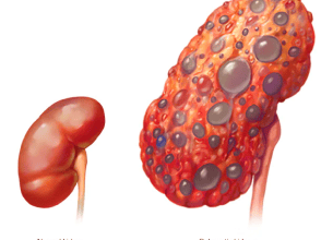 Hemodialysis and Peritoneal Dialysis: Comprehensive Renal 
                Replacement Therapies